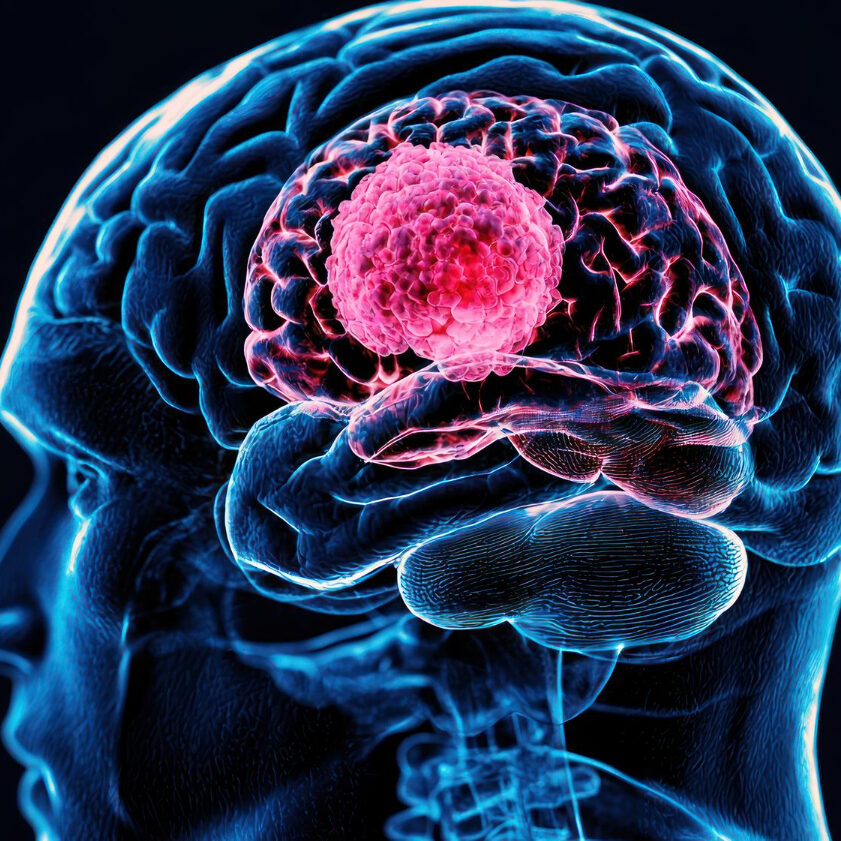 Όγκοι εγκεφάλου