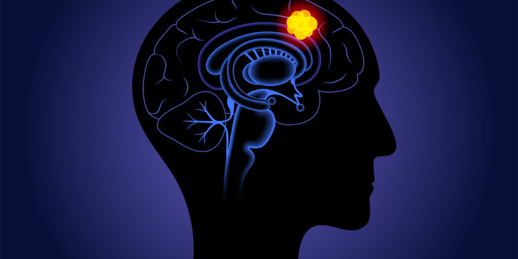 Γλοιοβλάστωμα