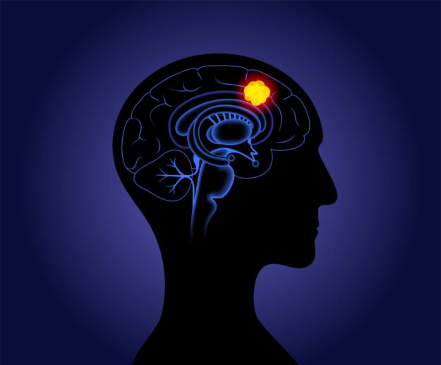 Γλοιοβλάστωμα Γλοιοβλάστωμα