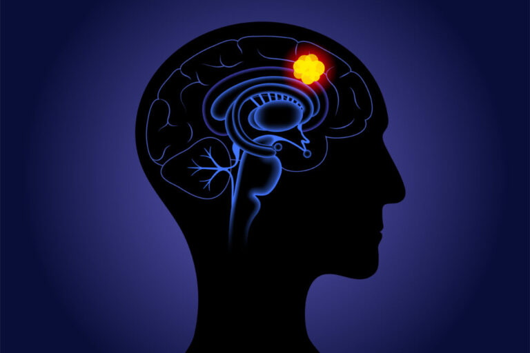 Γλοιοβλάστωμα