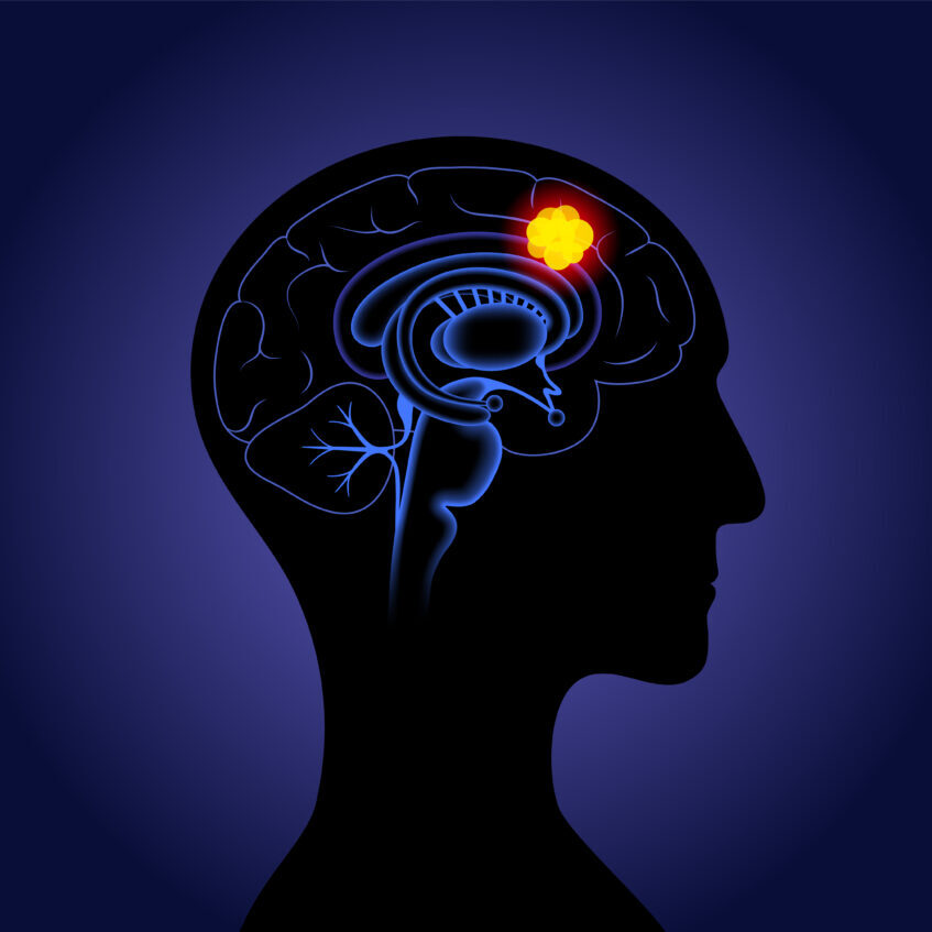 Γλοιοβλάστωμα