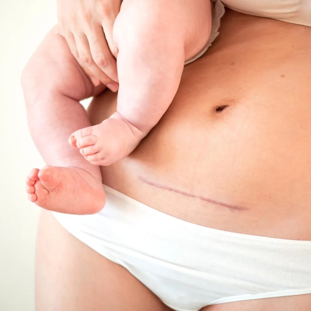 Κοιλιοπλαστική μετά από Καισαρική