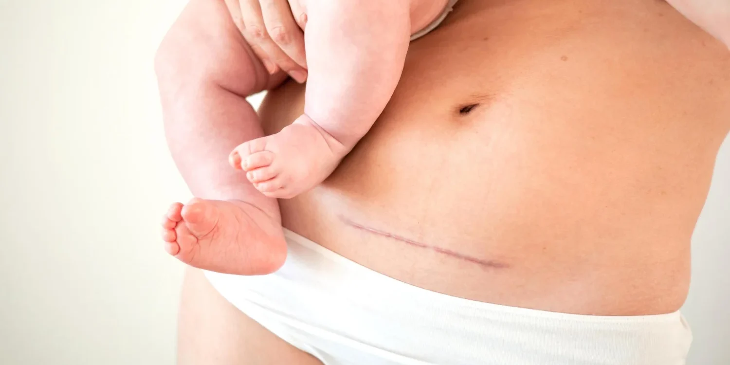 Κοιλιοπλαστική μετά από Καισαρική