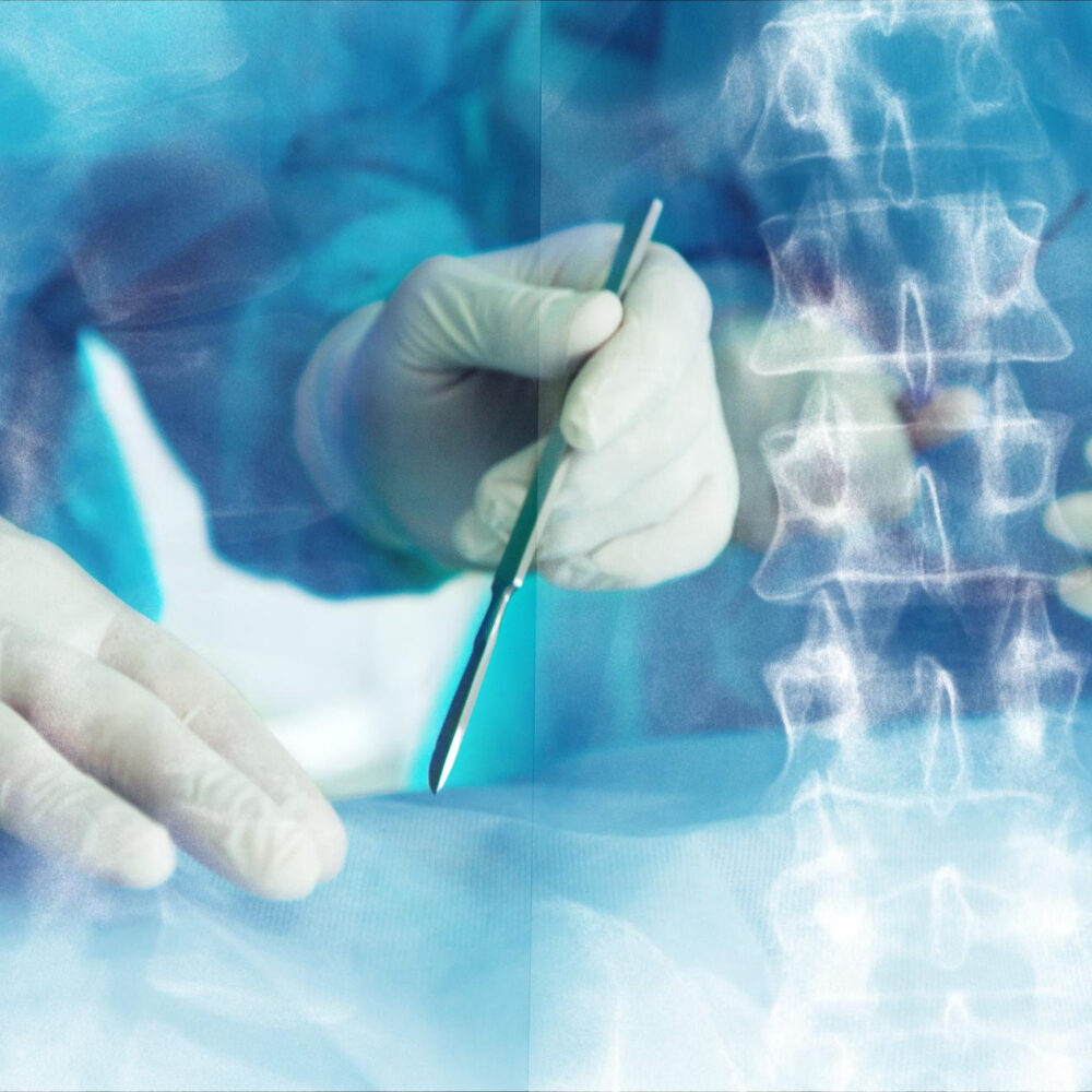 πότε κάνουμε σπονδυλοδεσία