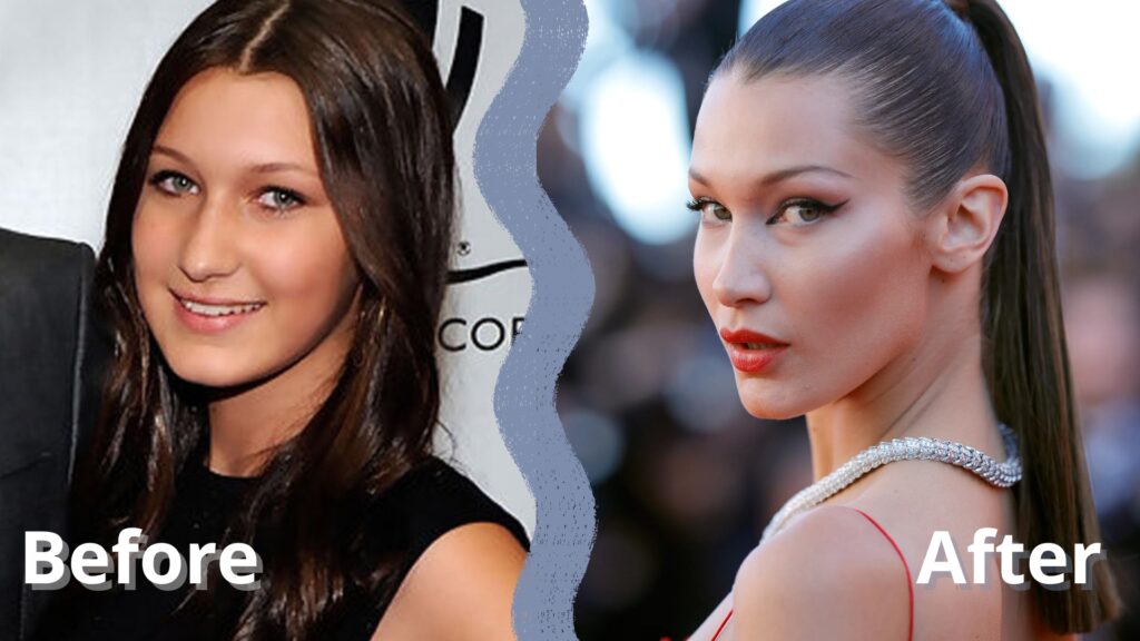 ρινοπλαστική διασήμων