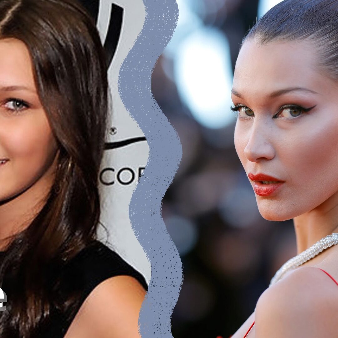 ρινοπλαστική διασήμων