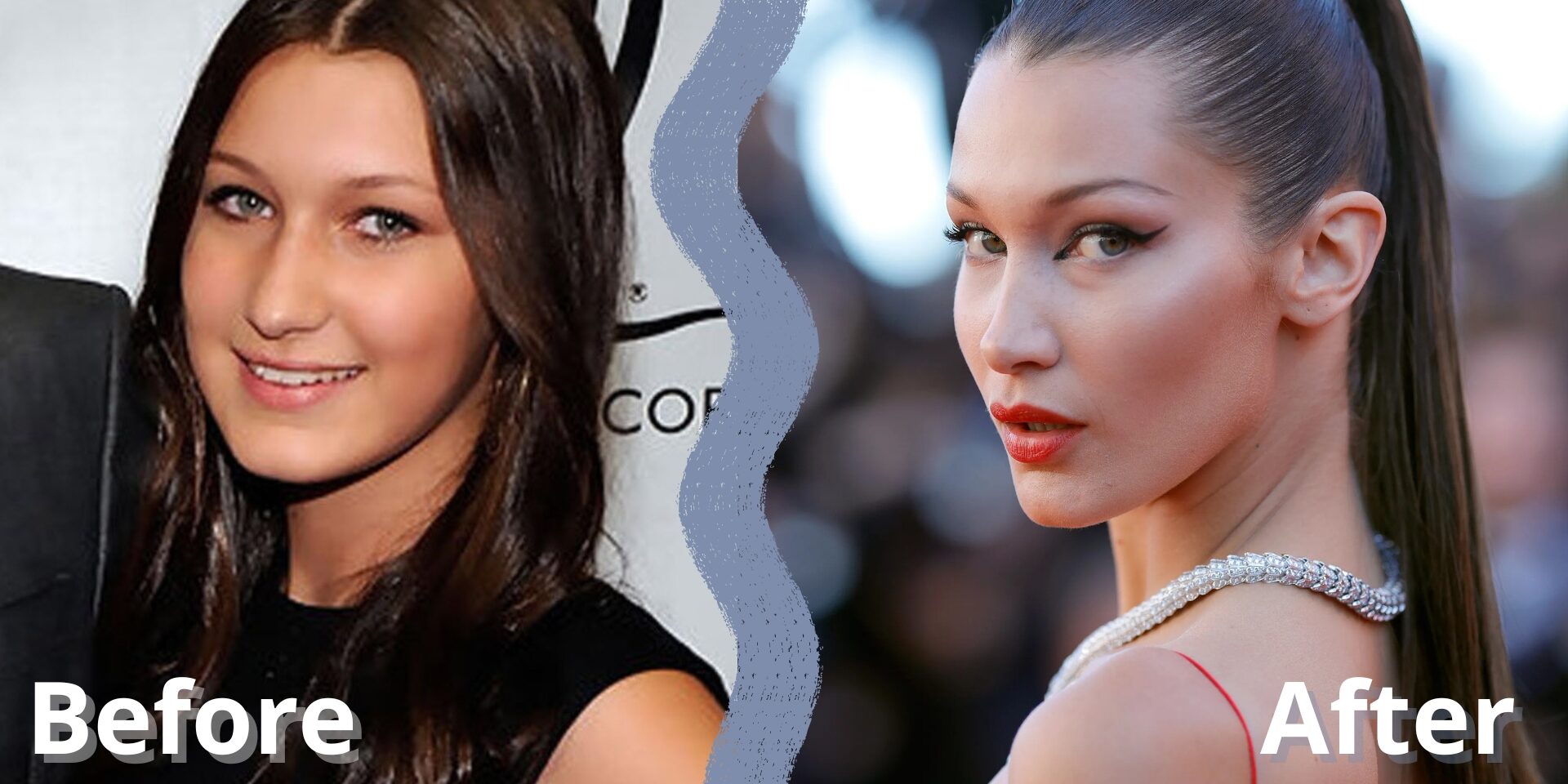 ρινοπλαστική διασήμων