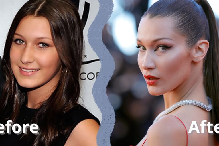 ρινοπλαστική διασήμων