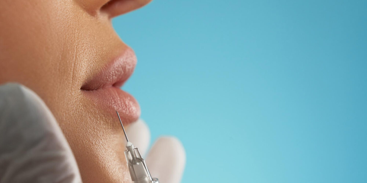 αποτυχημένο υαλουρονικό στα χείλη