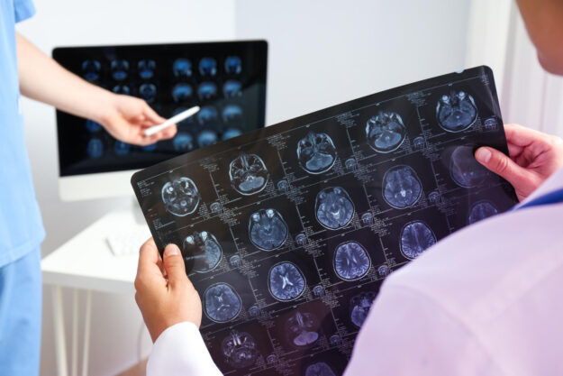 μηνιγγίωμα εγκεφάλου