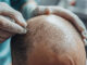 hair transplant
