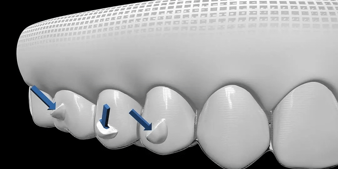 Invisalign attachments