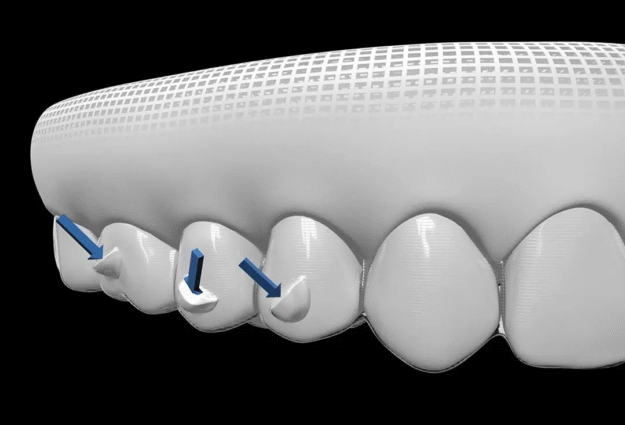 Invisalign attachments