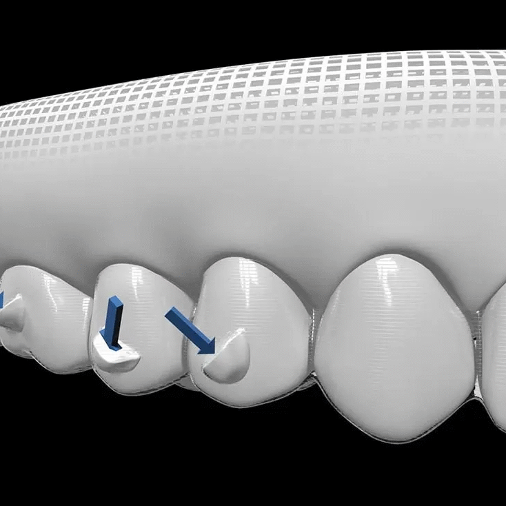 Invisalign attachments