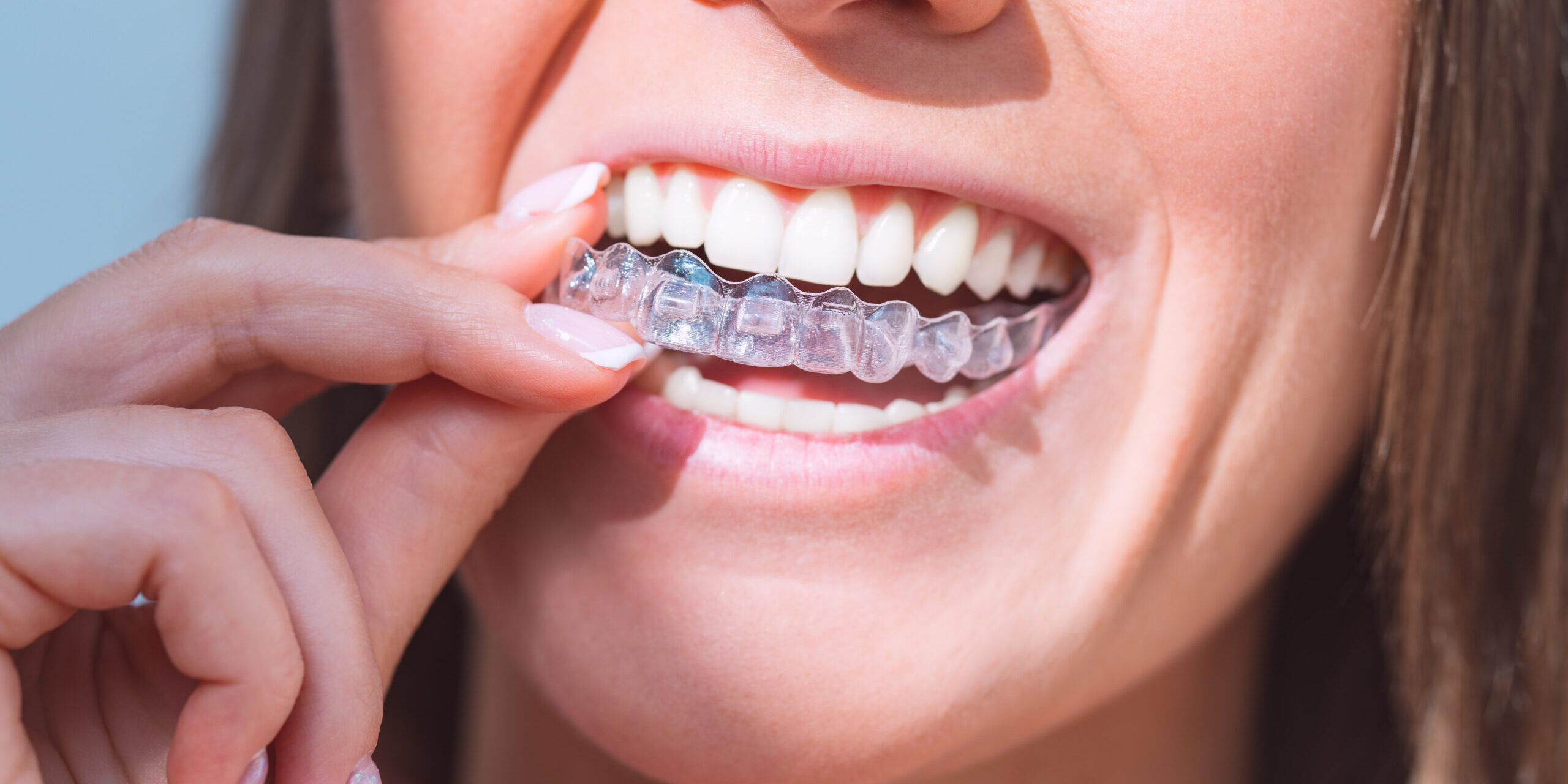 Invisalign πριν και μετά