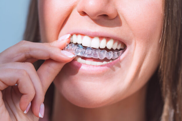 Invisalign πριν και μετά