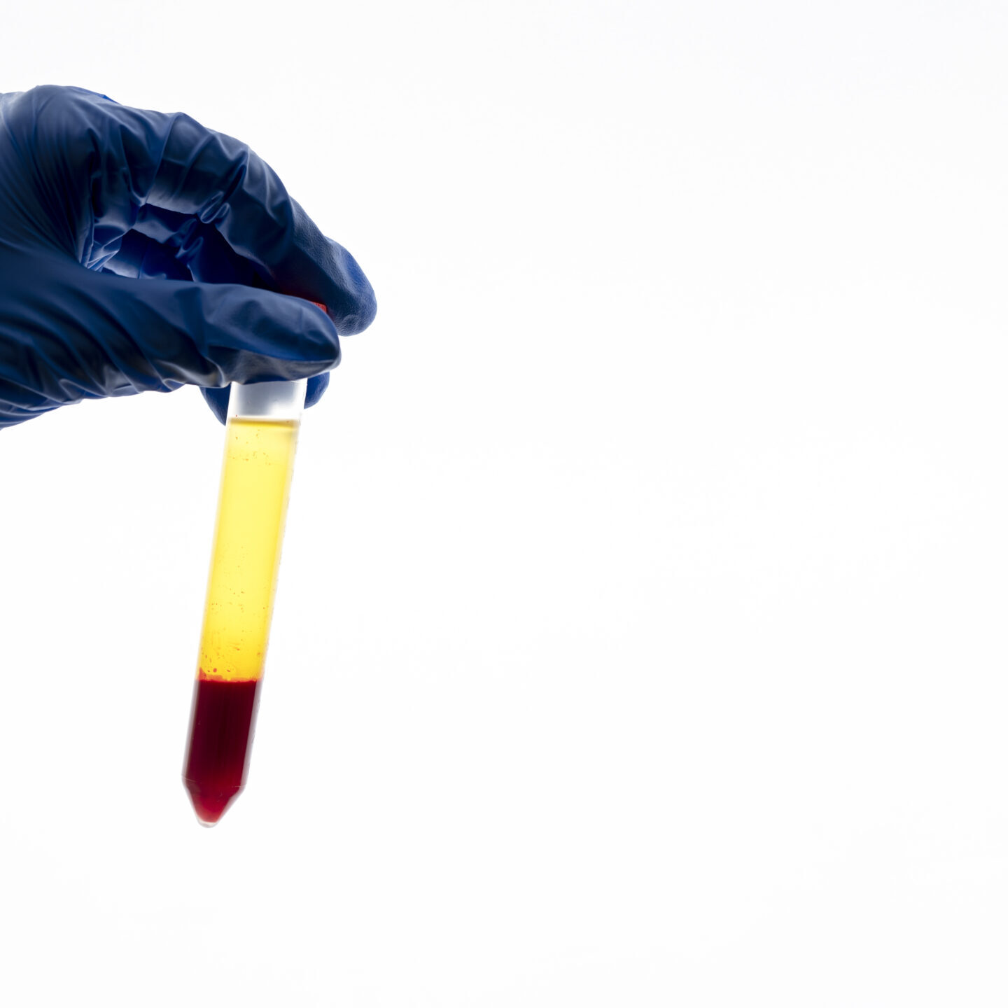 blood in urine