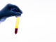 blood in urine