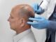 hair transplant athens