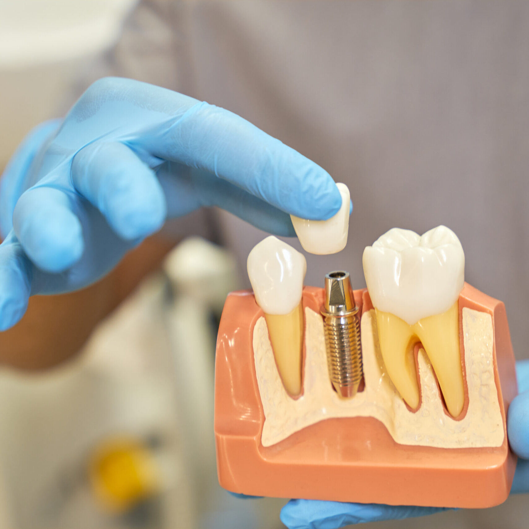 dental implants