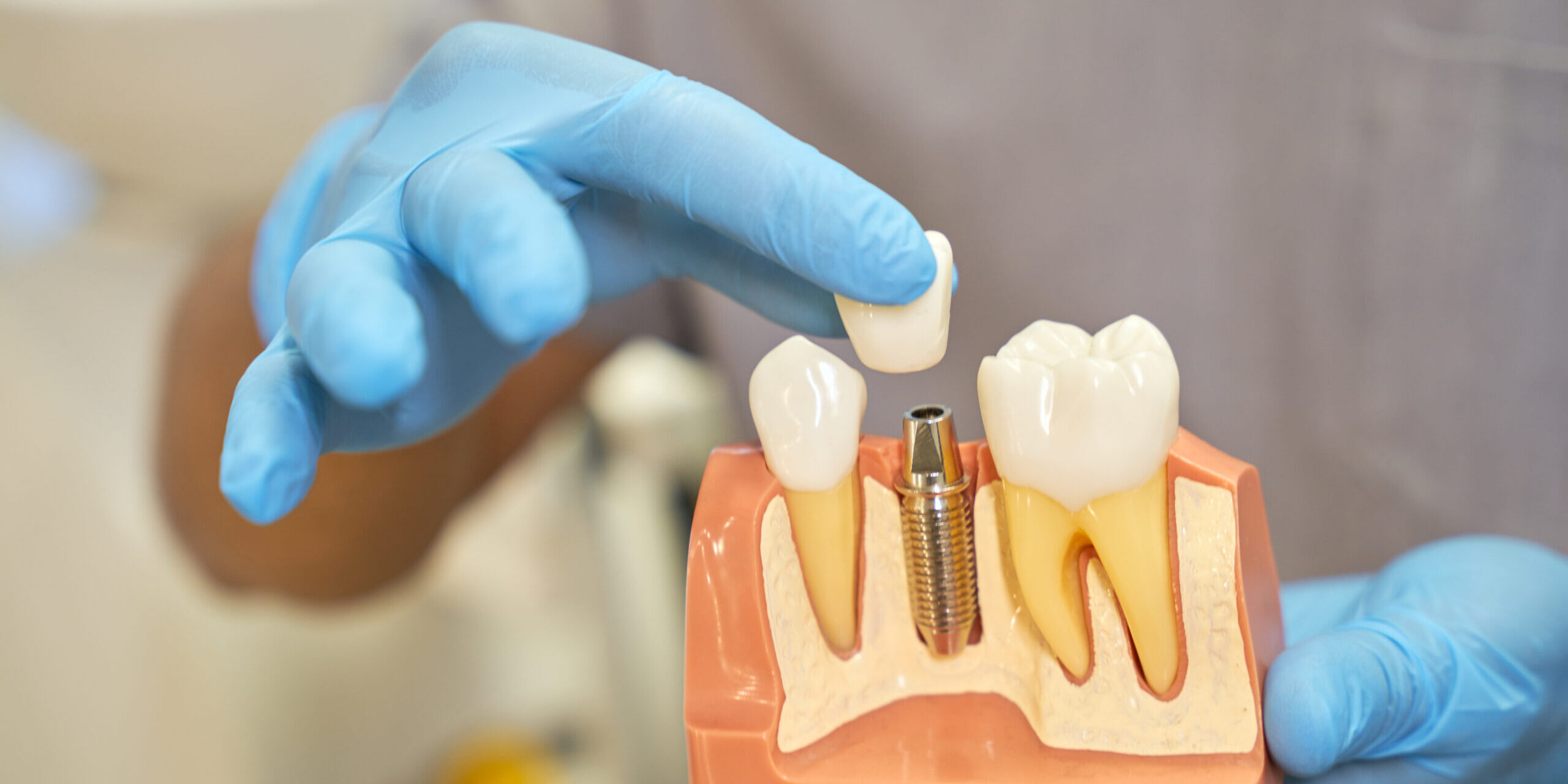 dental implants