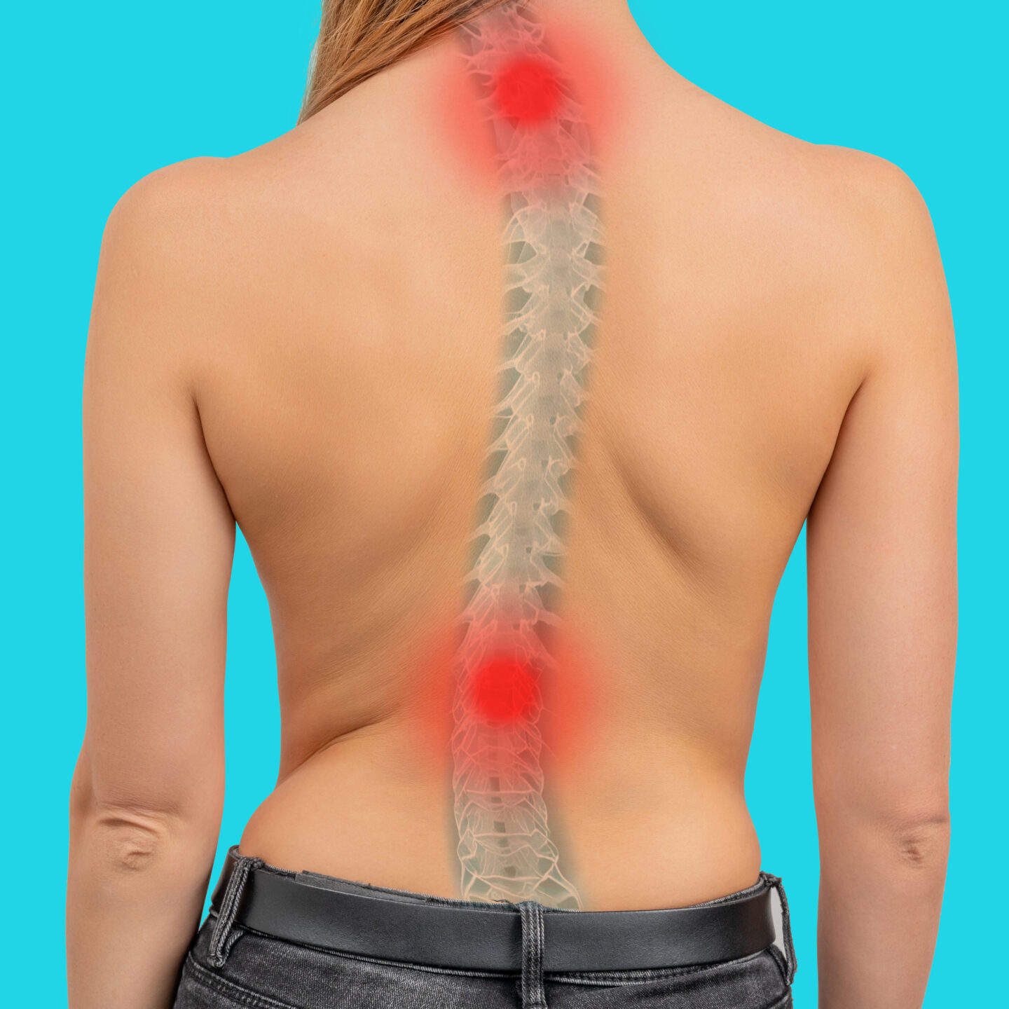 scoliosis