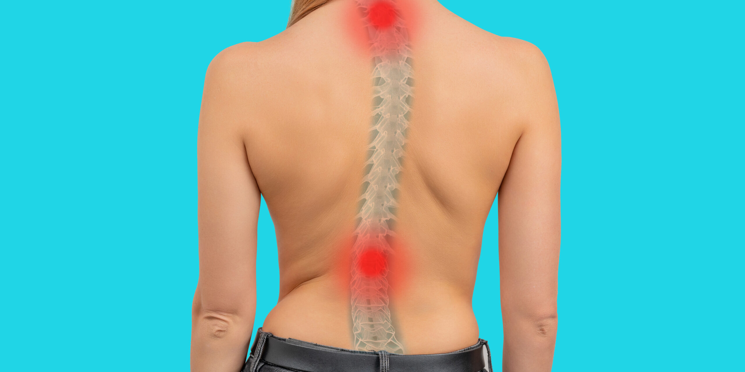 scoliosis