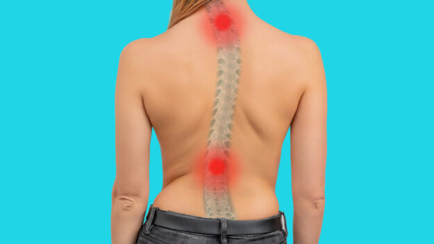 scoliosis