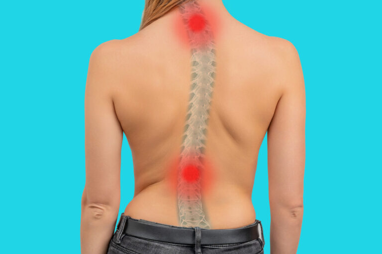 scoliosis