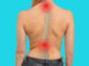 scoliosis