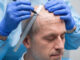 the best hair transplant clinic in Greece