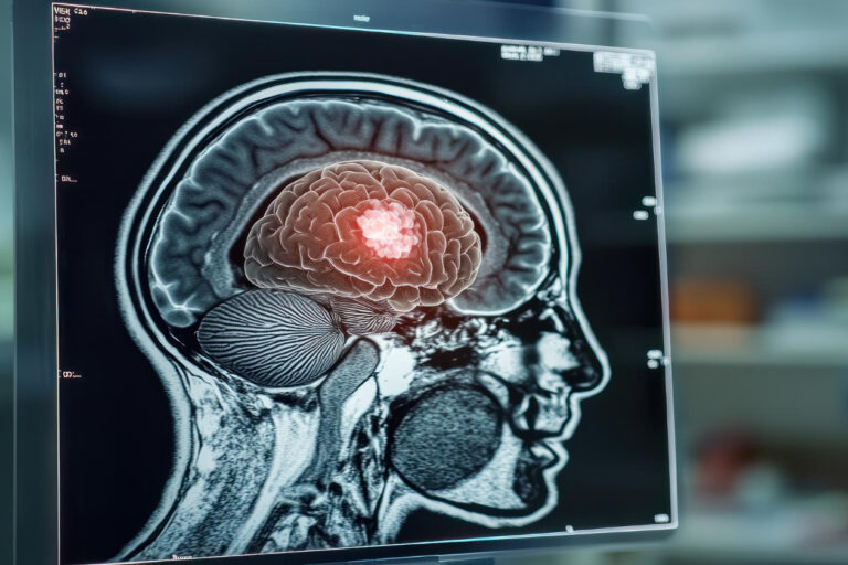 primary brain tumors primary brain tumors