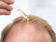 hair growth treatments