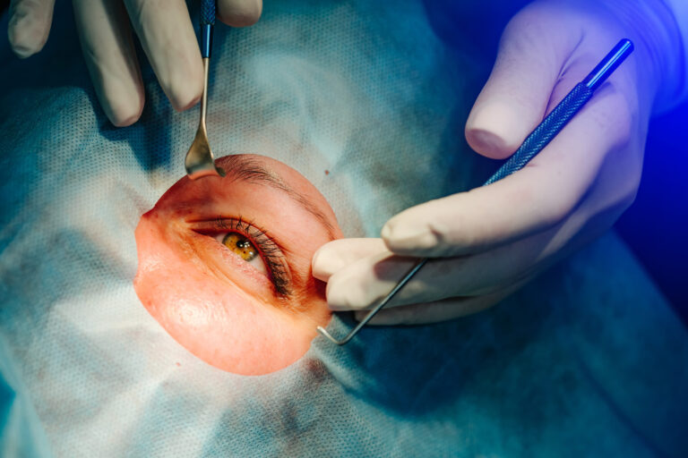LASIK Eye Surgery: What to expect before, during, and after the procedure