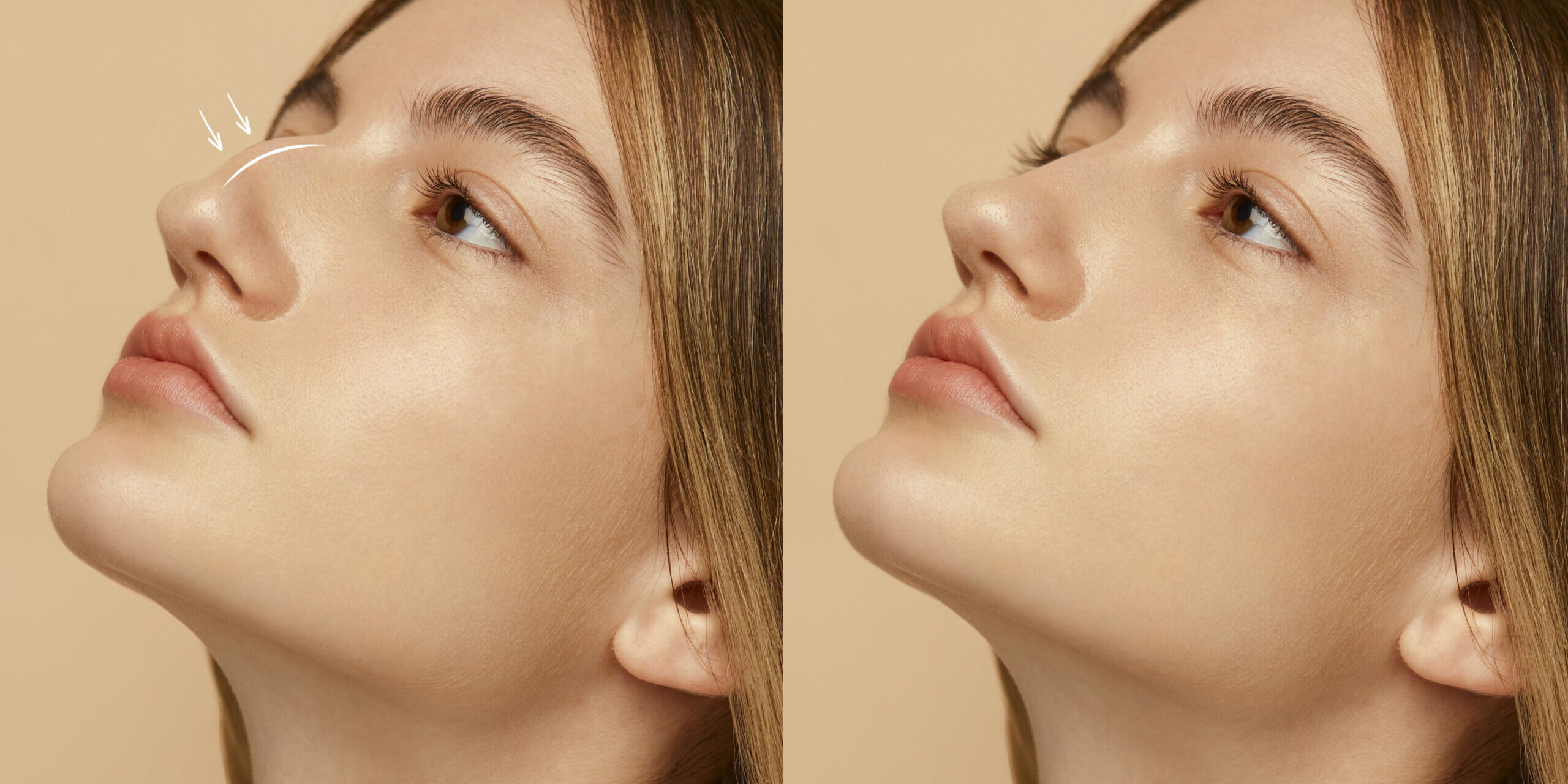 Rhinoplasty Recovery: What to Expect Week by Week After Nose Surgery Rhinoplasty Recovery: What to Expect Week by Week After Nose Surgery