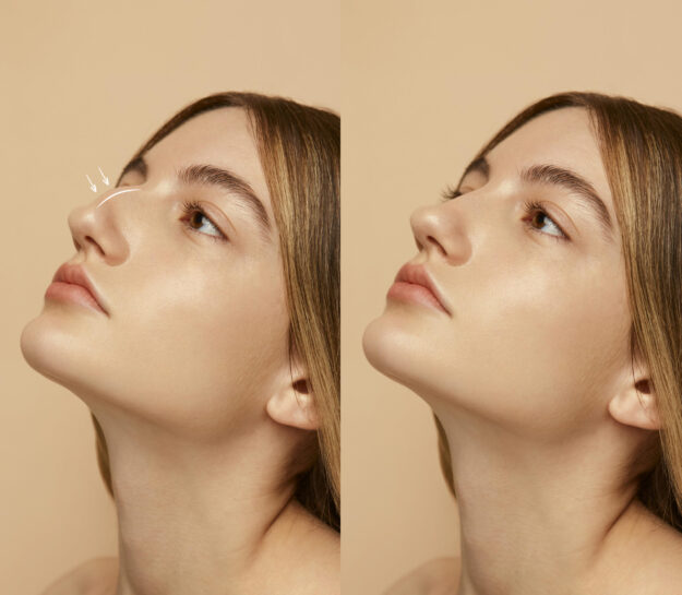 Rhinoplasty Recovery: What to Expect Week by Week After Nose Surgery