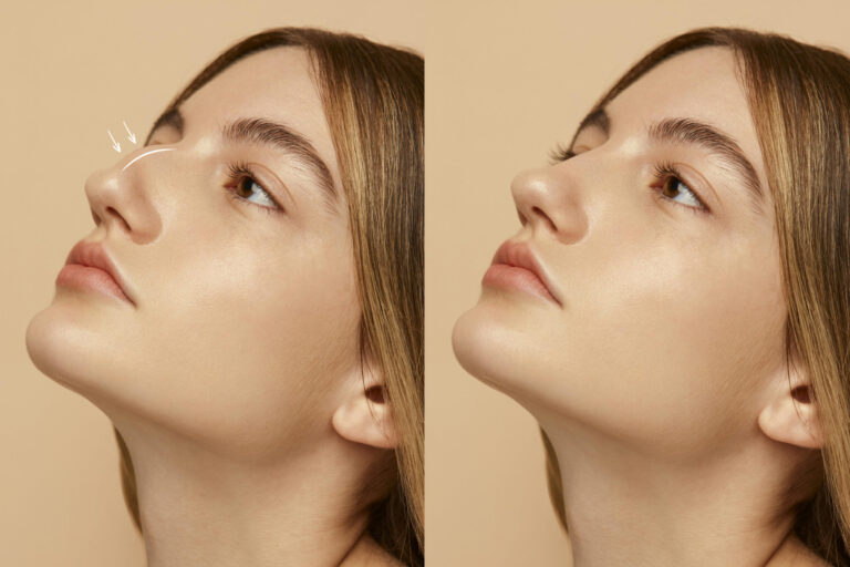 Rhinoplasty Recovery: What to Expect Week by Week After Nose Surgery Rhinoplasty Recovery: What to Expect Week by Week After Nose Surgery